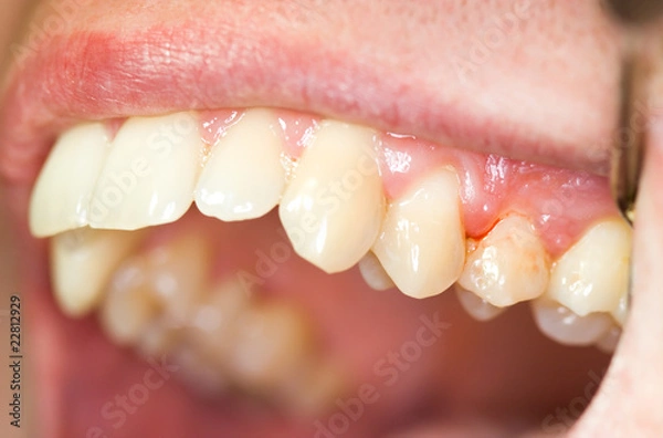 Fototapeta gingivitis