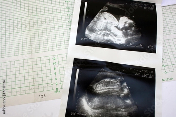 Obraz cardiograph and ultrasound