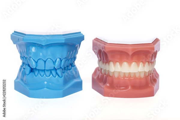 Obraz Orthodontic Teeth Models used in dentistry