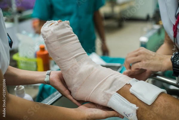 Fototapeta Patient with broken leg and splinted for treatment in the hospital.