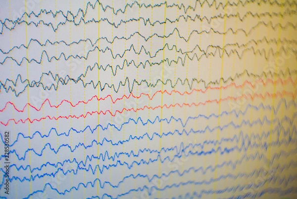 Obraz Computer monitor showing electrical activity of abnormal brain,EEG of the pediatric patients with problems in the brain.