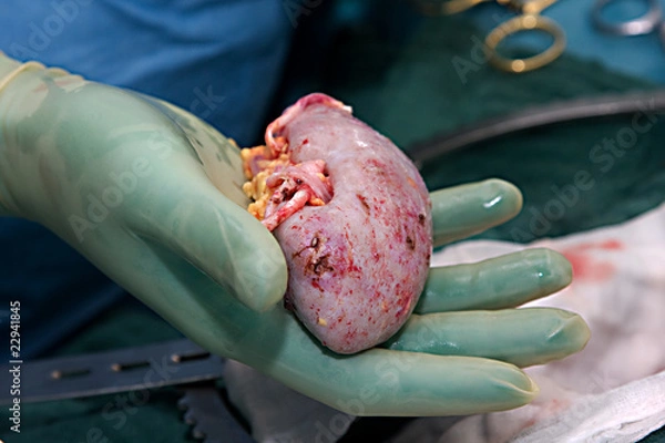 Obraz Nierentransplantation27