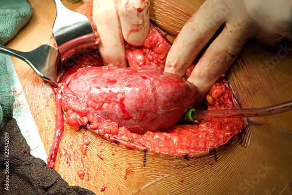 Obraz Nierentransplantation20