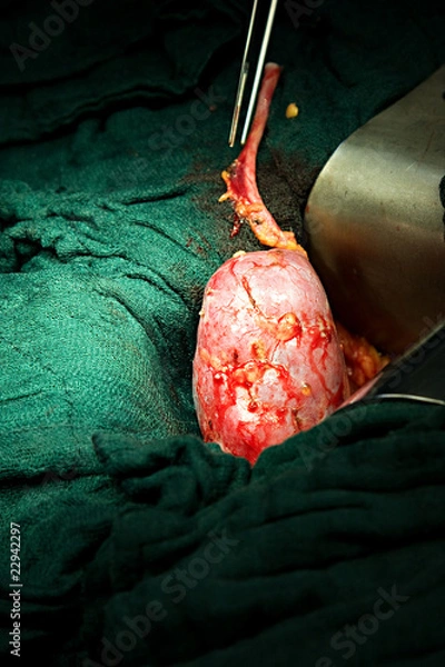 Obraz Nierentransplantation10