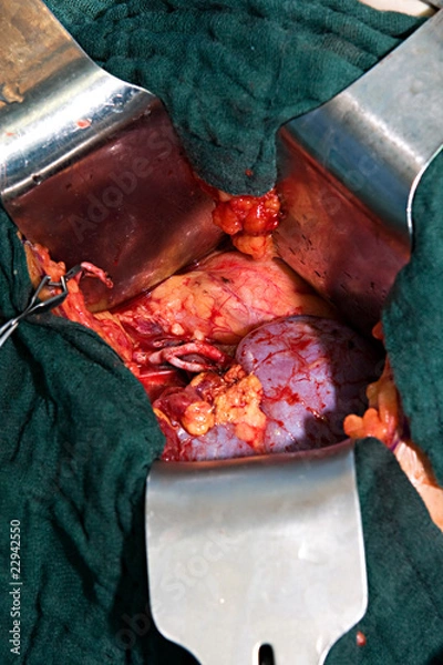 Obraz Nierentransplantation02
