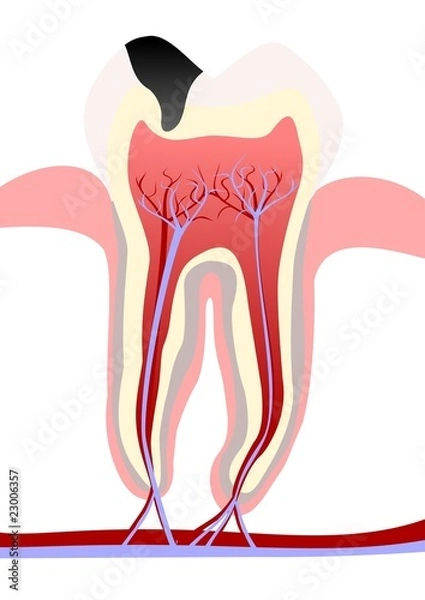 Obraz Tooth decay