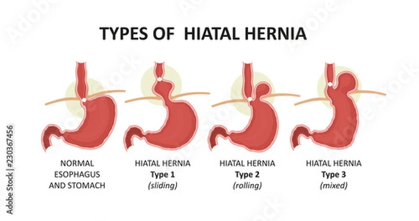Fototapeta types of hiatal hernia