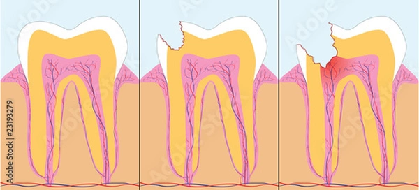 Fototapeta Three phase of caries, vector illustration