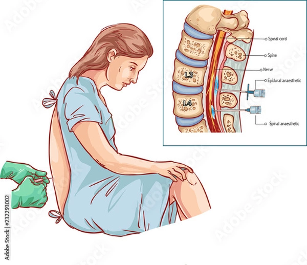 Obraz Epidural Nerve Block Injection