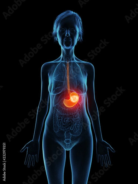 Fototapeta 3d rendered medically accurate illustration of an elder females stomach tumor