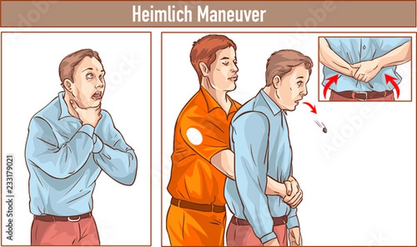 Obraz Clip Art of One man stands behind the conscious victim with his hands in the proper position on the victim's abdomen to perform the Heimlich maneuver