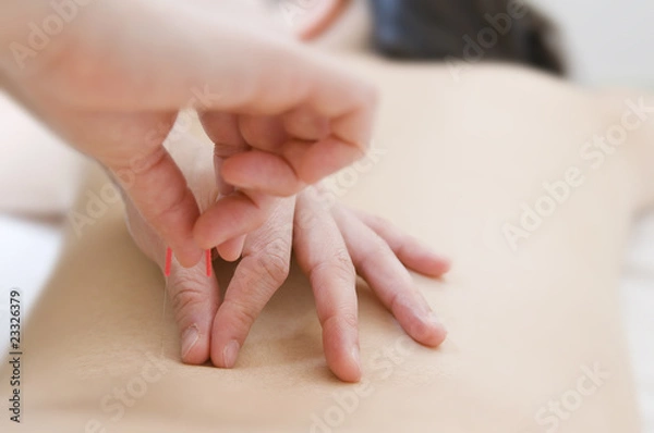 Fototapeta 鍼治療