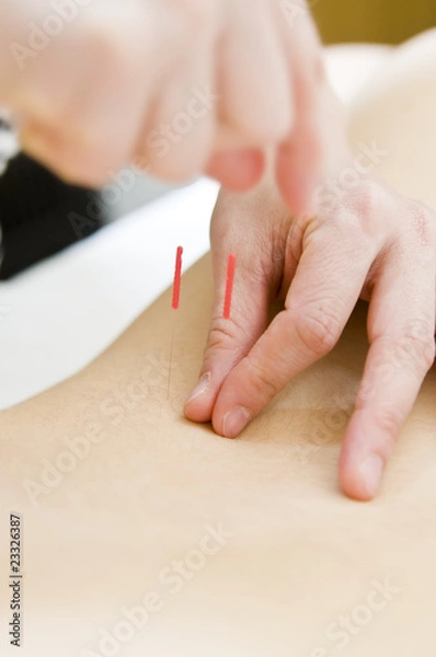 Obraz 鍼治療