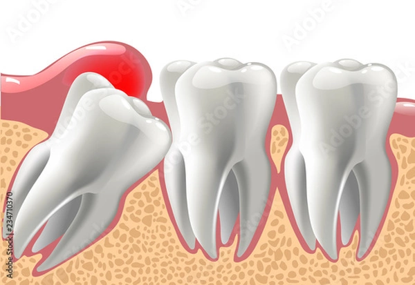 Fototapeta realistic 3D teeth, and wisdom tooth problems