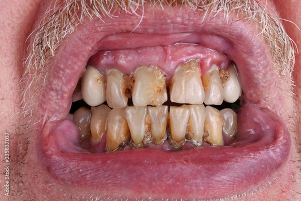 Obraz The teeth of an elderly man are spoiled by caries, tartar and poor waste  food macro