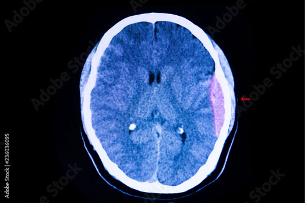 Obraz Brain CT scan,  epidural hemorrhage