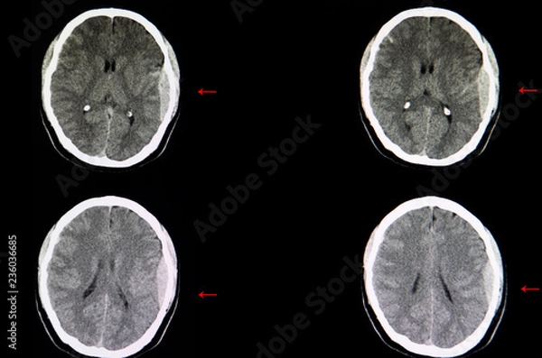 Fototapeta Brain CT scan,  epidural hemorrhage