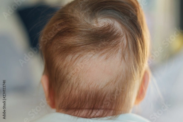 Fototapeta Bald spot at the back of baby's head 
