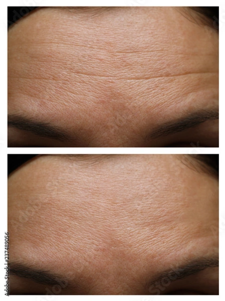 Obraz wrinkles on the forehead