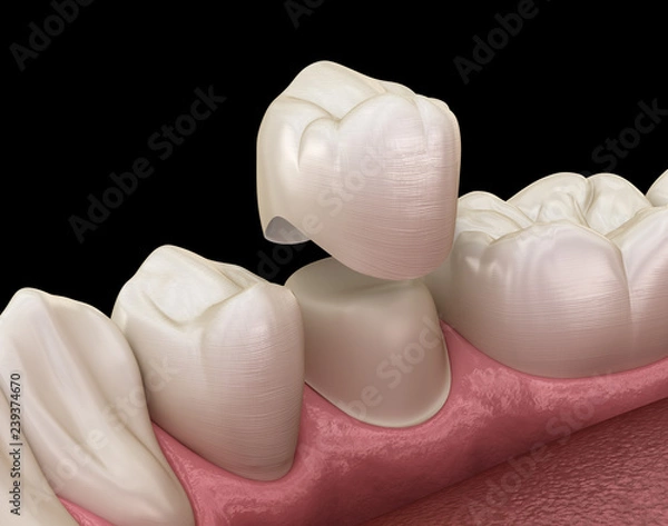 Obraz Proces montażu zęba przedtrzonowego korony dentystycznej. Medycznie dokładna ilustracja 3D leczenia ludzkich zębów