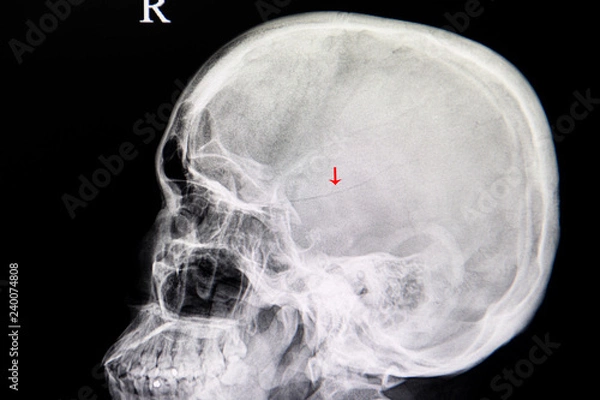 Fototapeta xray image of a patient with linear fracture skull from traumatic injury.