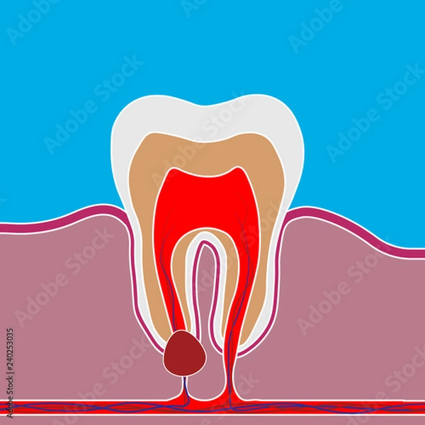 Fototapeta Flat style of dental disease with pain and inflammation. Medical illustration of tooth root inflammation, tooth root cyst, pulpitis.