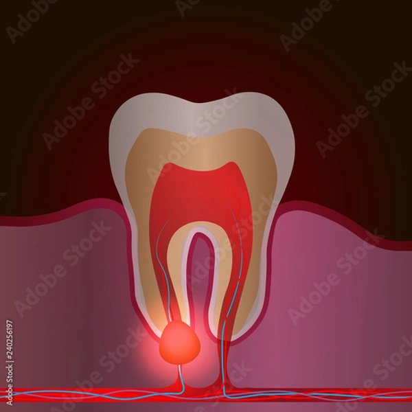Fototapeta dental disease with pain and inflammation. Medical illustration of tooth root inflammation, tooth root cyst, pulpitis.