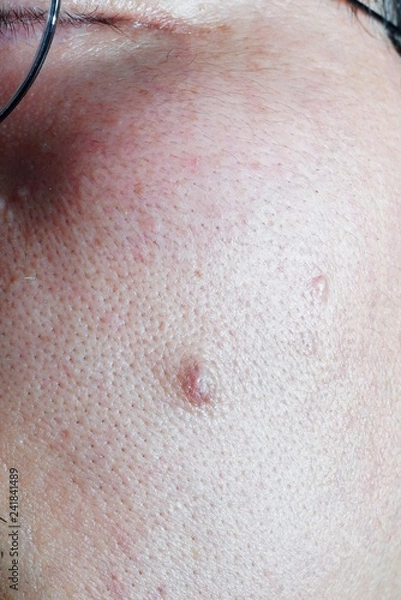 Obraz Wart on the skin