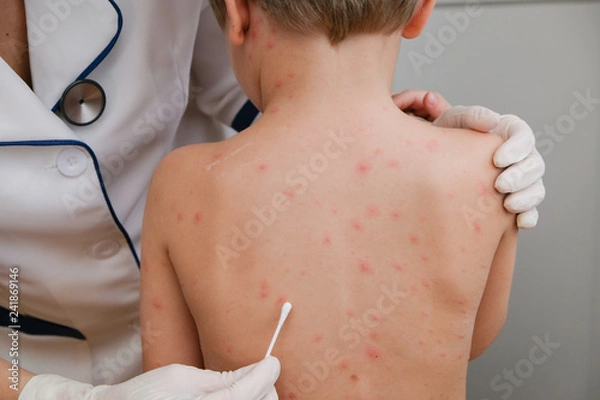 Fototapeta Doctor applying cream to baby's skin with blisters and rash caused by chickenpox
