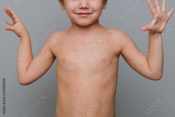 Fototapeta Closeup of baby's skin full of blisters,scar and rash caused by chickenpox