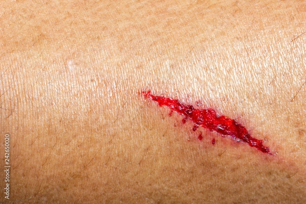 Obraz Closeup deep wounds from sharp objects on human skin.
