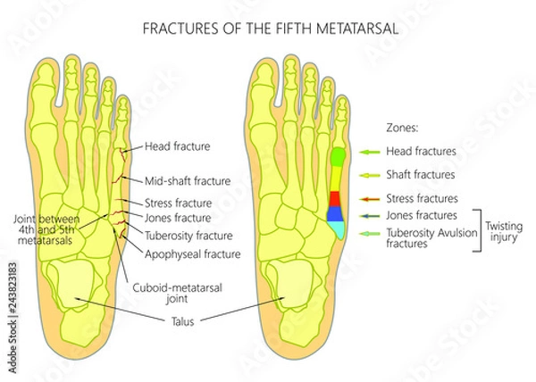 Fototapeta Illustration (diagram) of the 5th metatarsal Fractures (types and zones classification) in the foot.