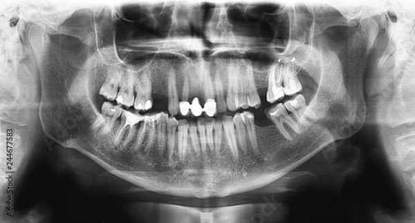Fototapeta Panoramic radiograph is a panoramic scanning dental X-ray of the upper and lower jaw. This is a focal plane tomography shows the maxilla and mandible of a forty year old man.