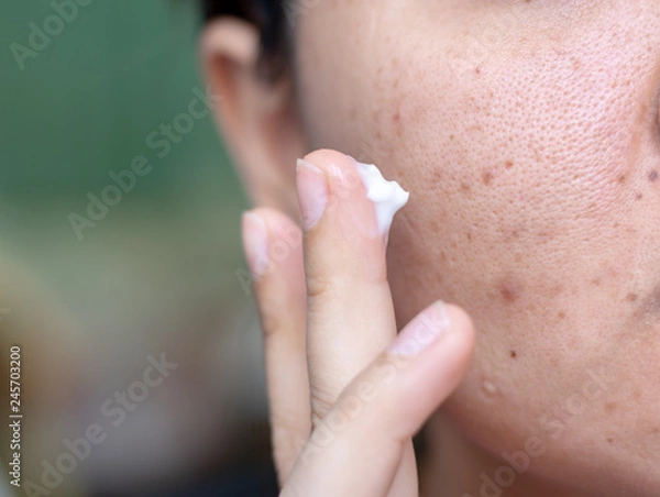 Fototapeta Woman applying cream onto face that has problem problematic skin , acne scars ,oily skin and pore, dark spots and blackhead and whitehead on the face.