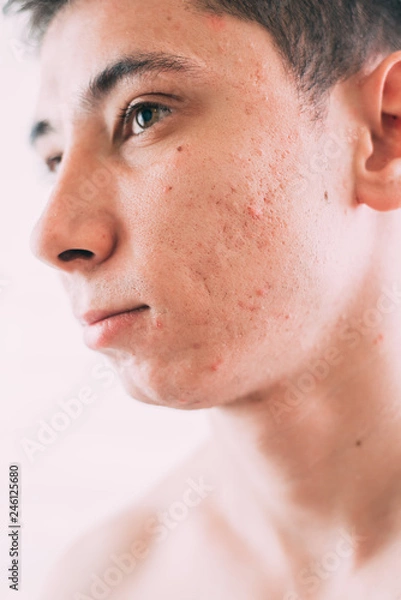 Obraz Man with problematic skin and scars from acne
