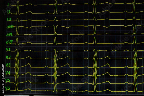 Obraz Screen of electrocardiograph device showing twelve yellow ECG cardiography heart rythm leads.