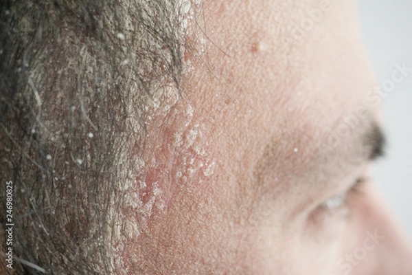 Fototapeta psoriasis on the hairline and on the scalp-close up, dermatological diseases, skin problems