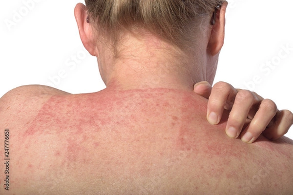 Obraz Pflasterallergie Hand rechts am Rücken