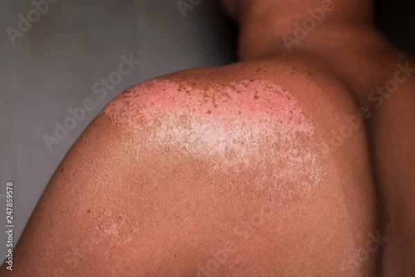 Fototapeta man with reddened, itchy skin after sunburn.