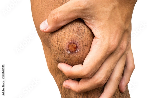 Fototapeta Hand holding on knee with scratch wound isolated on white background.