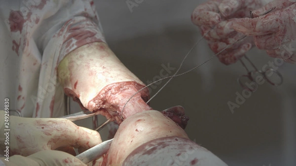 Obraz Amputation With Gigli Saw