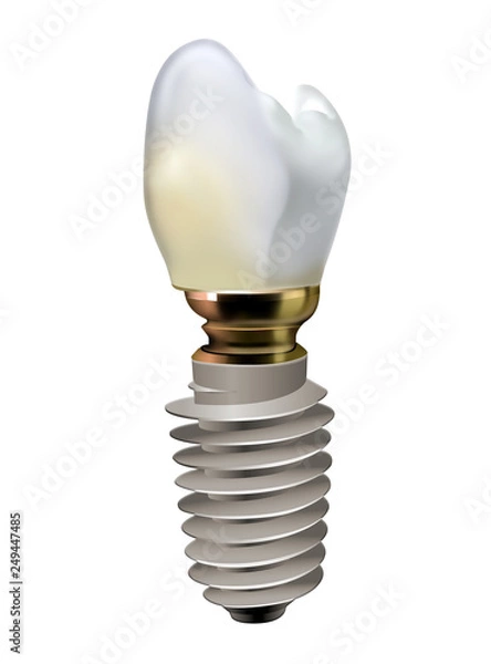 Obraz teeth implant illustration