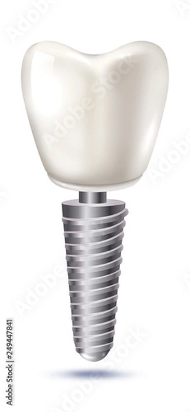 Obraz teeth implant illustration