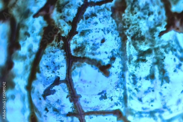 Fototapeta Human squamous cell carcinoma. Tissues affected by cancer cells under a microscope