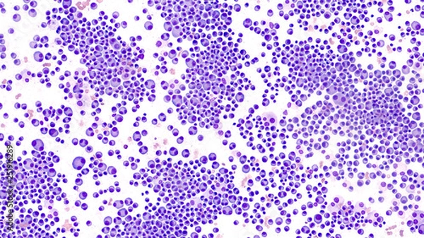 Fototapeta Multiple Myeloma Awareness: Bone marrow aspirate cytology of multiple myeloma, a type of bone marrow cancer of malignant plasma cells, associated with bone pain, bone  fractures and anemia.