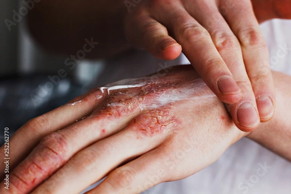 Fototapeta Eczema on the hands. The man applying the ointment , creams in the treatment of eczema, psoriasis and other skin diseases. Skin problem concept