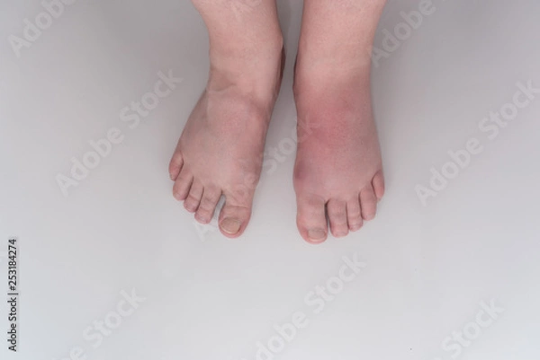 Fototapeta Füße mit Gichtanfall