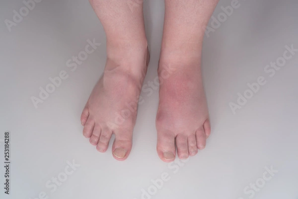 Obraz Rot geschwollener Fuß