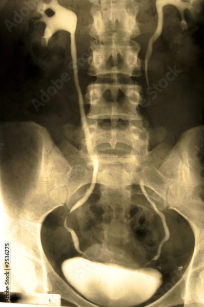Obraz bladder xray
