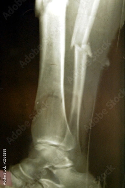 Obraz limb fracture